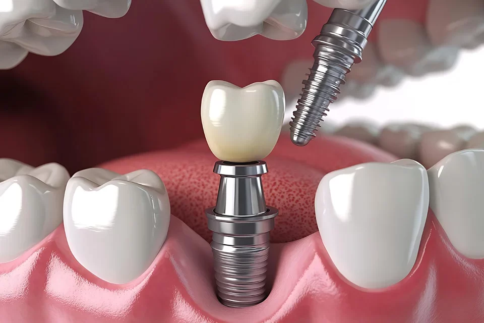 Dental-Implamts-01